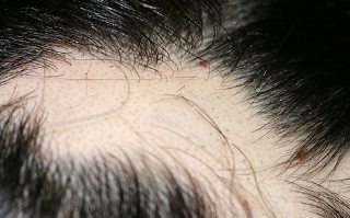 用梅花针怎么治疗斑秃,梅花针治疗斑秃方法