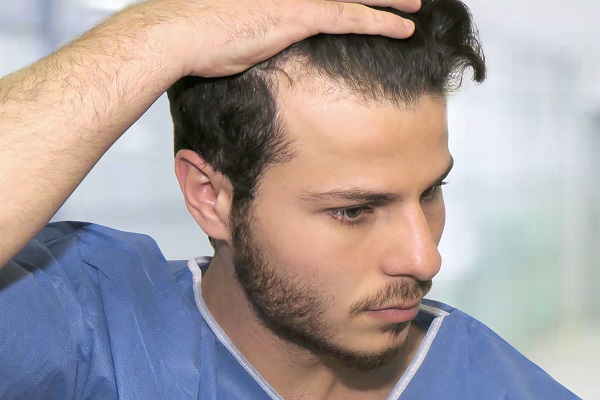 男性脱发原因及治疗