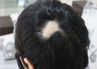 自体毛发移植术可以遮挡疤痕吗?