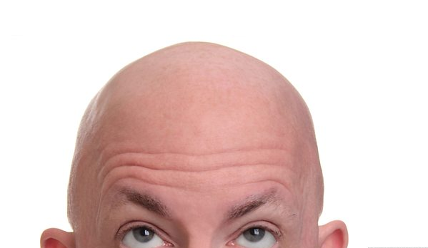 脂溢性脱发会发展成秃顶吗