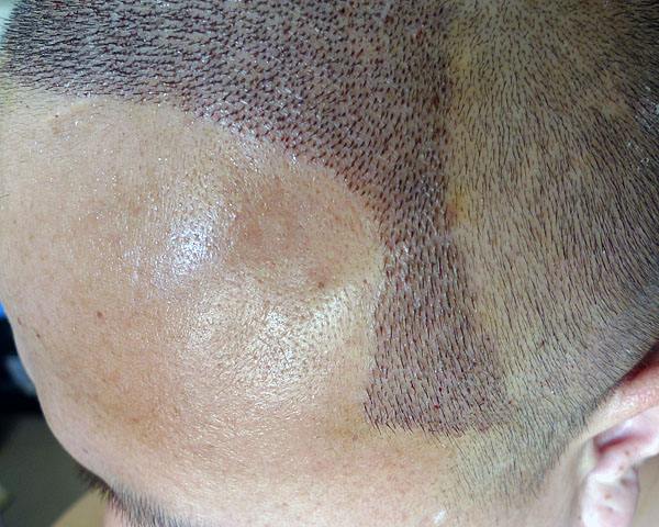 植发有什么危害 当心植发后遗症问题