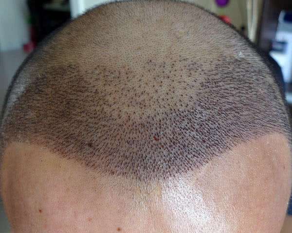 植发能保持多久 植发怎么做