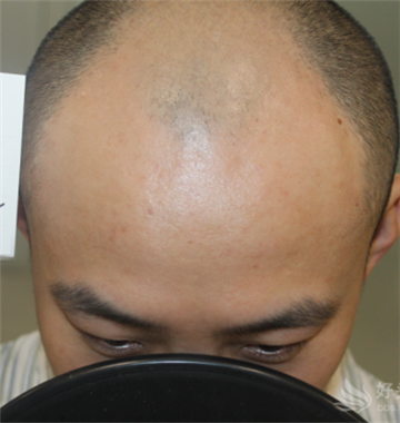 五级脱发植发效果 直击提取毛囊手术现场！