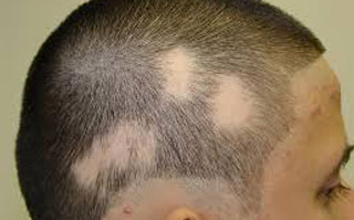 男士突然大面积脱发是什么情况，可以恢复吗？