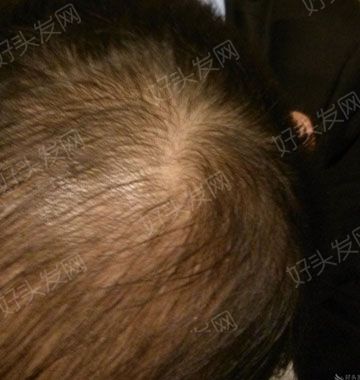 遗传性雄脱如何治疗?5级脱发患者的真实写照！
