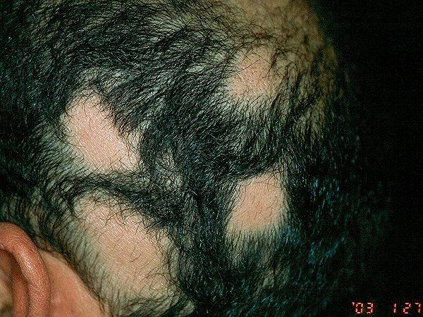 斑秃的治疗方法