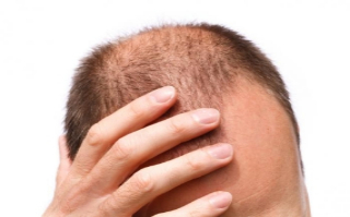 男性植发有用么?或许这是治疗脱发的圣杯