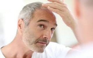 治疗男性雄性激素脱发