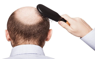 男性26岁脱发怎么治疗
