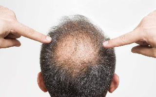 男性脱发中医能治疗吗?