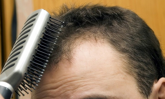 男性脱发可以植发吗