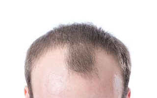 男性治疗脱发的方法