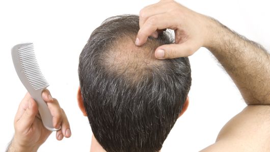 男性脱发真的不能治疗吗 