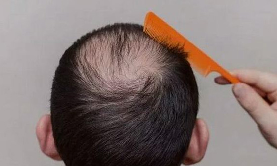 男性如何治疗脱发
