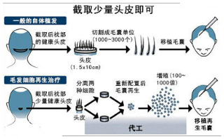 治疗男士脱发的新技术