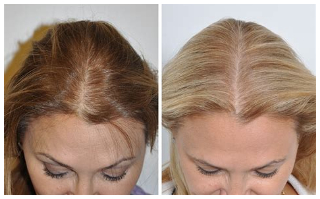 女性头发加密恢复期多久