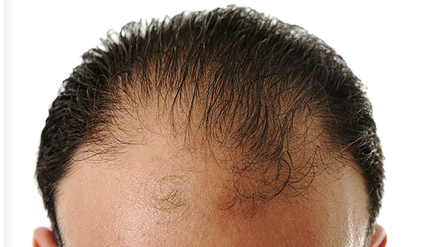 四十岁男人脱发的原因是什么