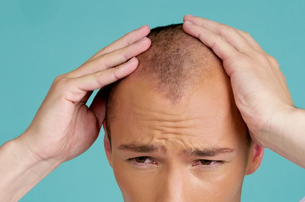 男人头顶脱发原因及治疗