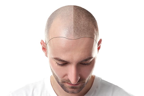 秃顶植发副作用,秃顶植发有什么危害