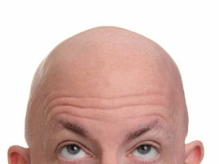 男性脱发与脂溢性脱发的区别