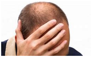 秃顶植发能长久吗,秃顶植发能保持多久
