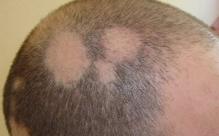 梅花针治疗斑秃需要多久时间