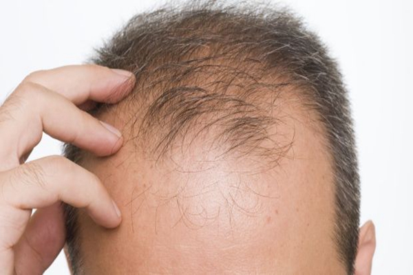 中年男性脱发怎么治