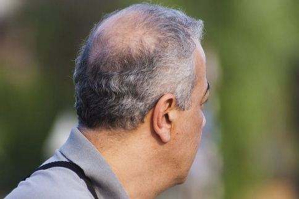 中年男人脱发的原因 中年男性为什么脱发