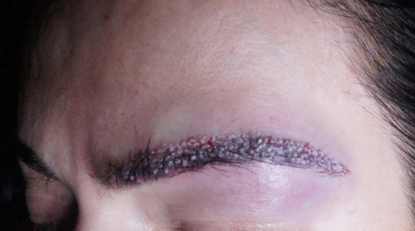 种植眉毛的坏处 眉毛种植的危害,种植眉毛后遗症