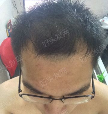 广州植发：前额三级脂溢性脱发