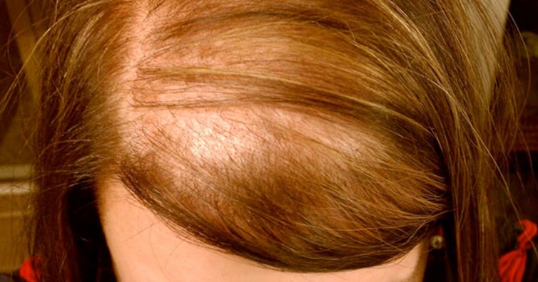 脂溢性脱发怎么办，脂溢性脱发可以根治吗?