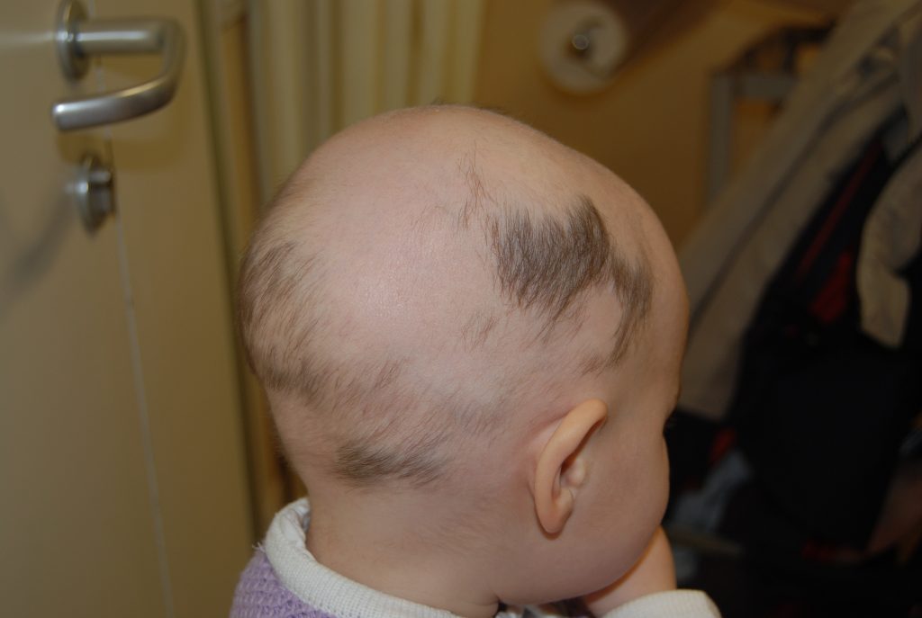 小儿斑秃可以治愈吗?小儿斑秃的病因是什么?