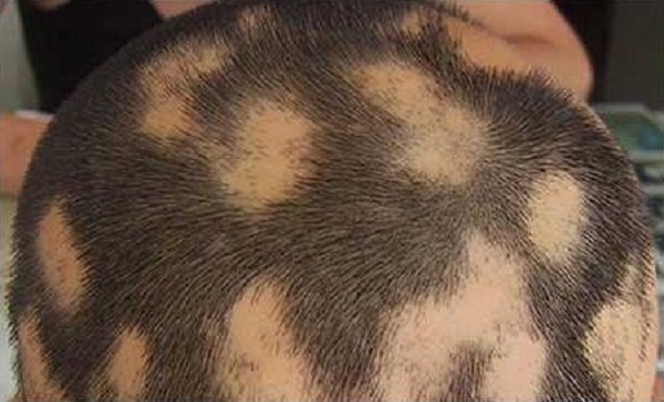 斑蝥治疗斑秃的用法，斑秃的原因