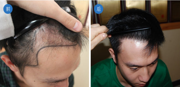 植头发真的有效果吗?头发种植的手术步骤