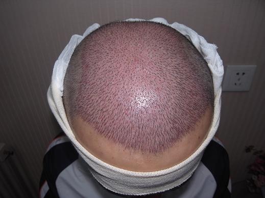 什么是fue自体毛发种植手术，哪些人适合自体毛发移植?