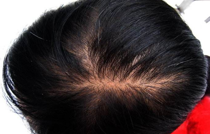 女脂溢性脱发吃什么药? 女性患有脂溢性脱发日常应注意什么?