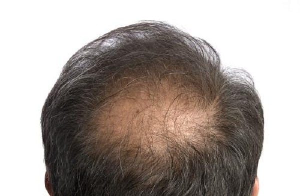 男性激素正常，但还是脱发是什么原因