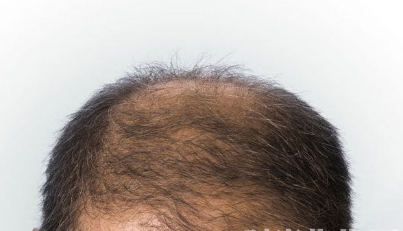 男性治疗脱发有什么特效药