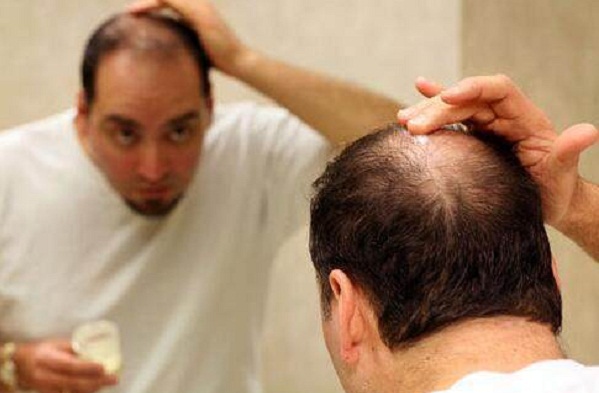 男生脱发主要是什么原因