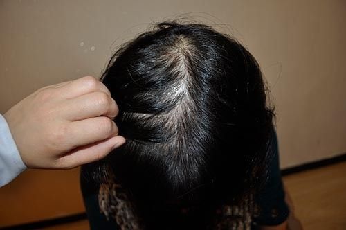 落健能治疗遗传性脱发吗?