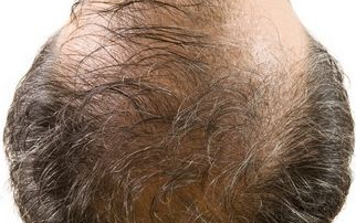 男性局部脱发的原因及治疗方法