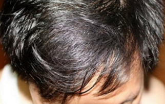 男性脱发原因及治疗