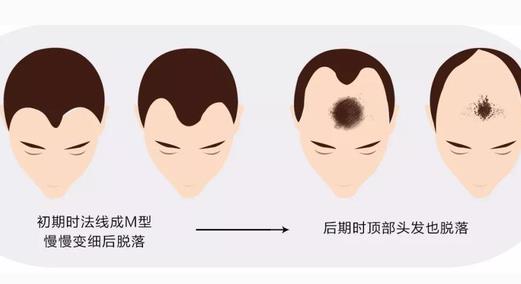 北京男性植发医院哪家好