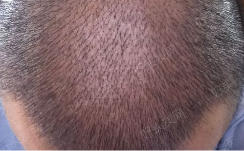 男性植发有危害吗?