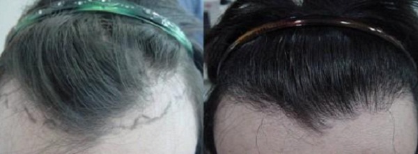 女生植发需要多久有效果