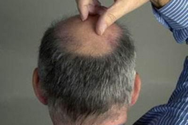 保列治能治疗男性脱发吗