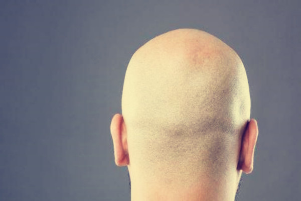 男性内分泌失调脱发怎么治疗