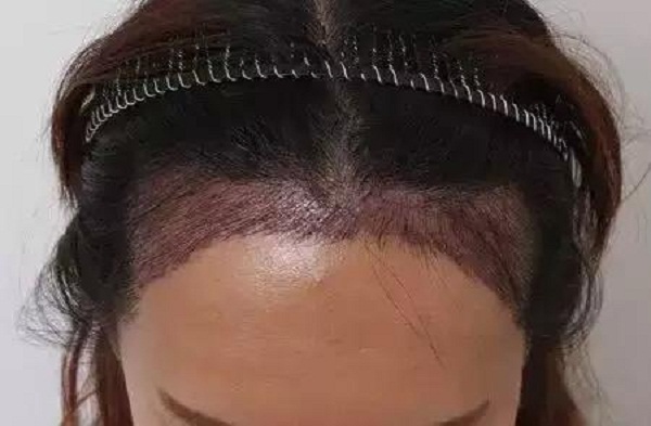 女生植发需要多长时间
