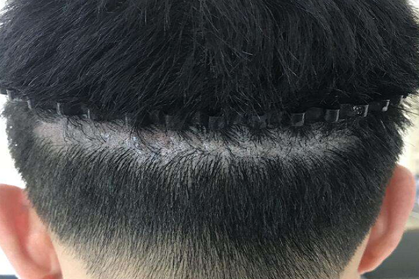 头部疤痕能否种植头发
