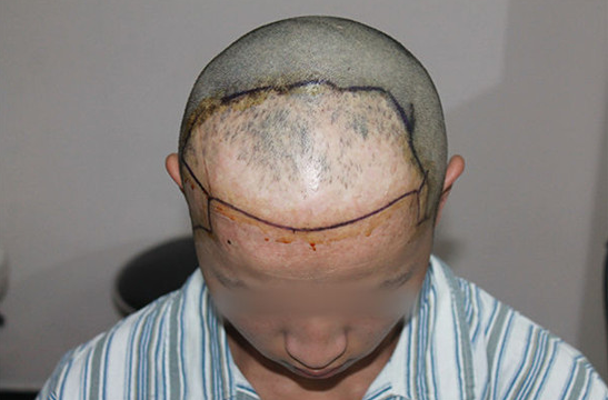 头皮疤痕植发手术多少钱